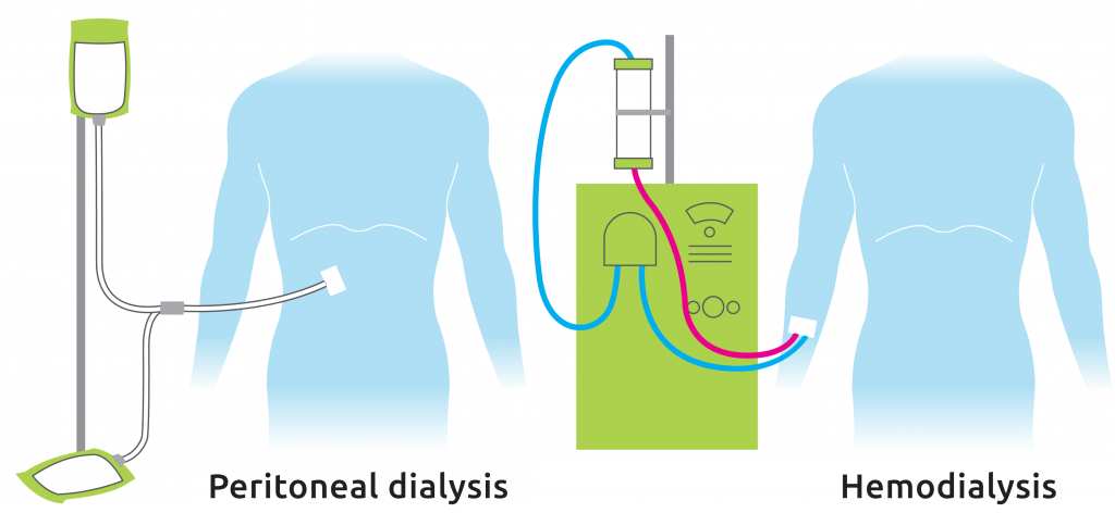 2 Types Dialysis sidebyside Transplant Living