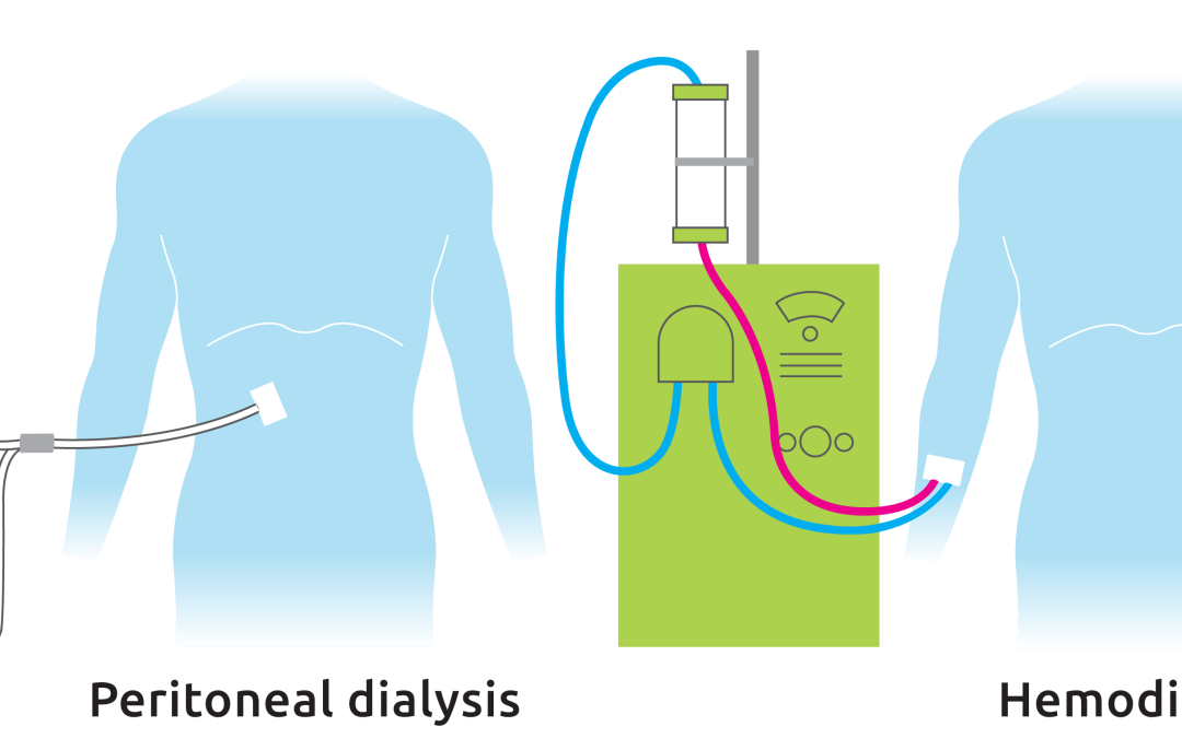 2 types dialysis-sidebyside