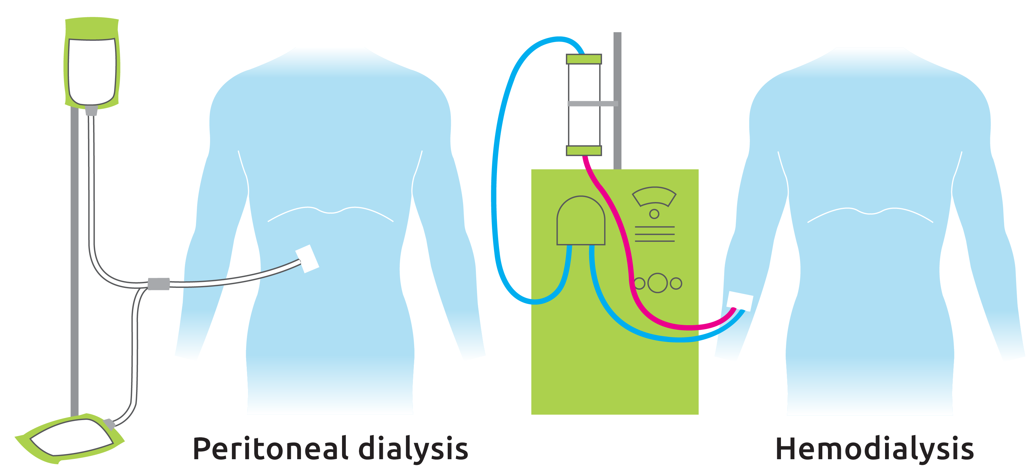 what-are-the-dialysis-options-transplant-living