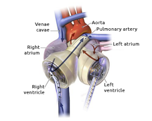 Diagram of an artificial heart.