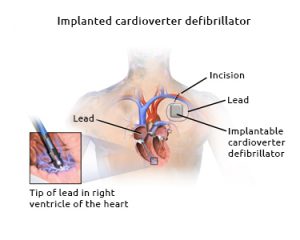 Implantable cardioverter defibrillator device. Creative Commons - Bruce Blaus