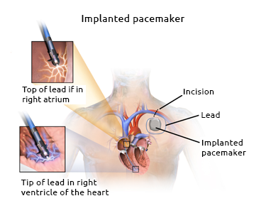 Diagram of an implanted pacemaker. Source: Creative Commons - Blausen.com