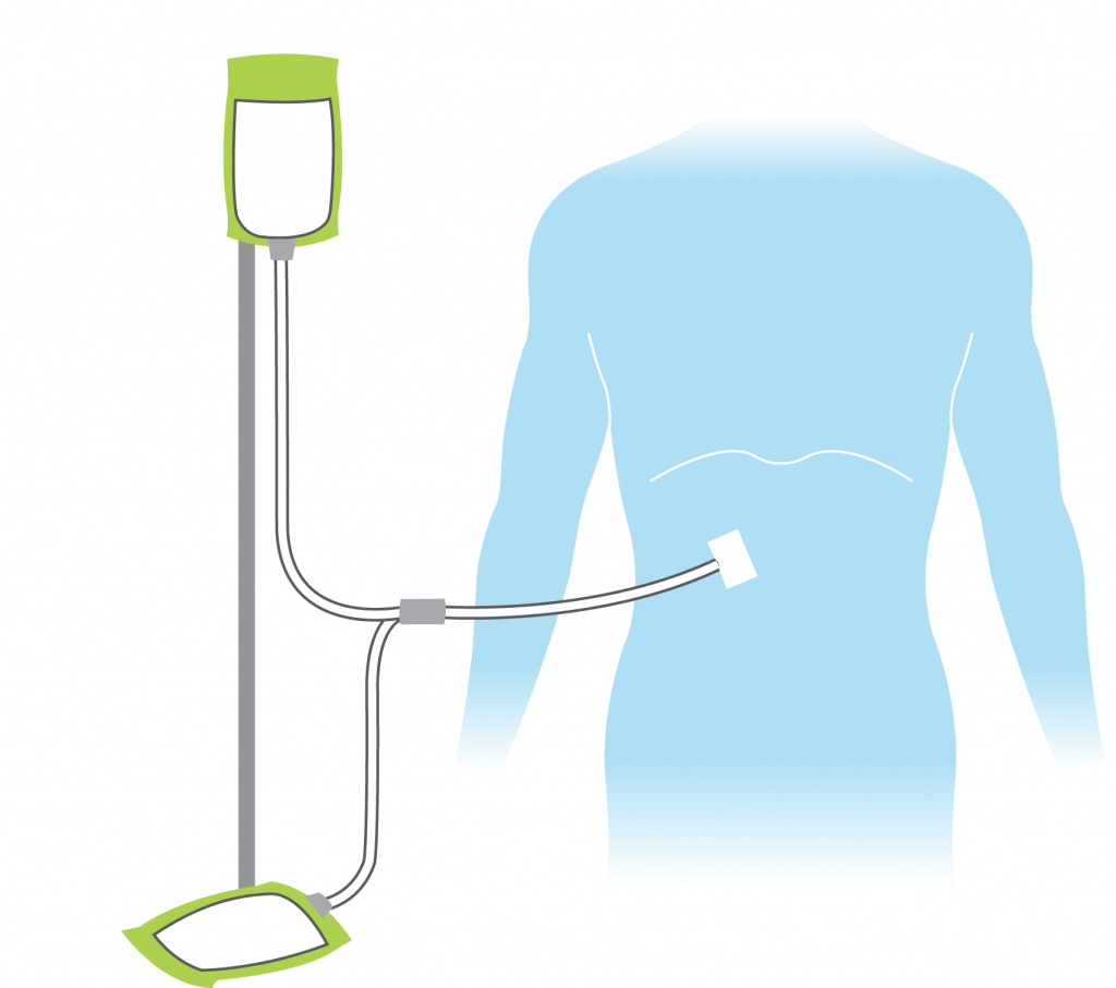 What are the dialysis options? | Transplant Living