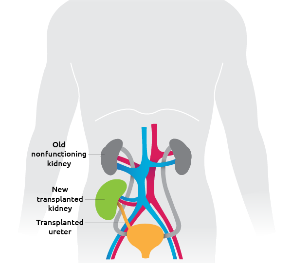 torso-transplanted-kidneys